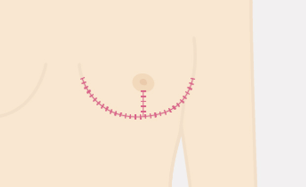 吊り上げ法の術後イメージ