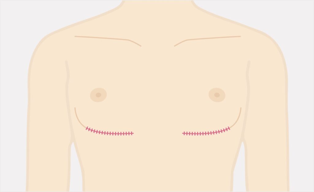 乳腺・乳房脂肪除去+皮膚除去の術後イメージ