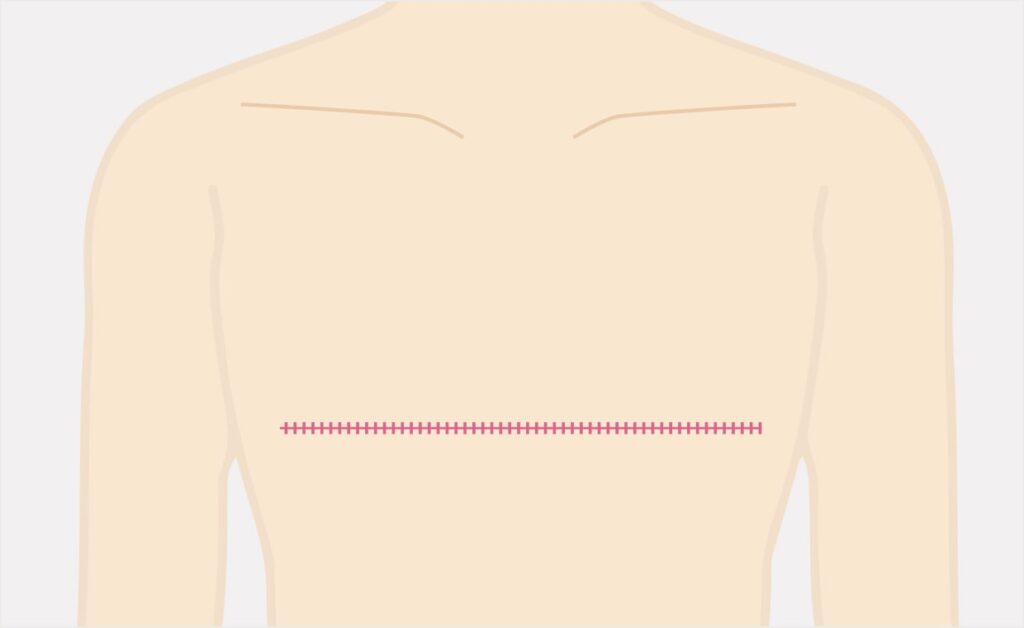 乳房全切除の術後イメージ