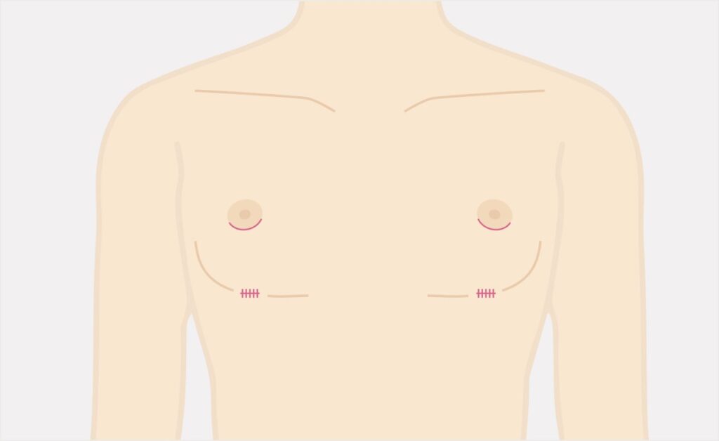 乳腺・乳房脂肪除去の術後イメージ
