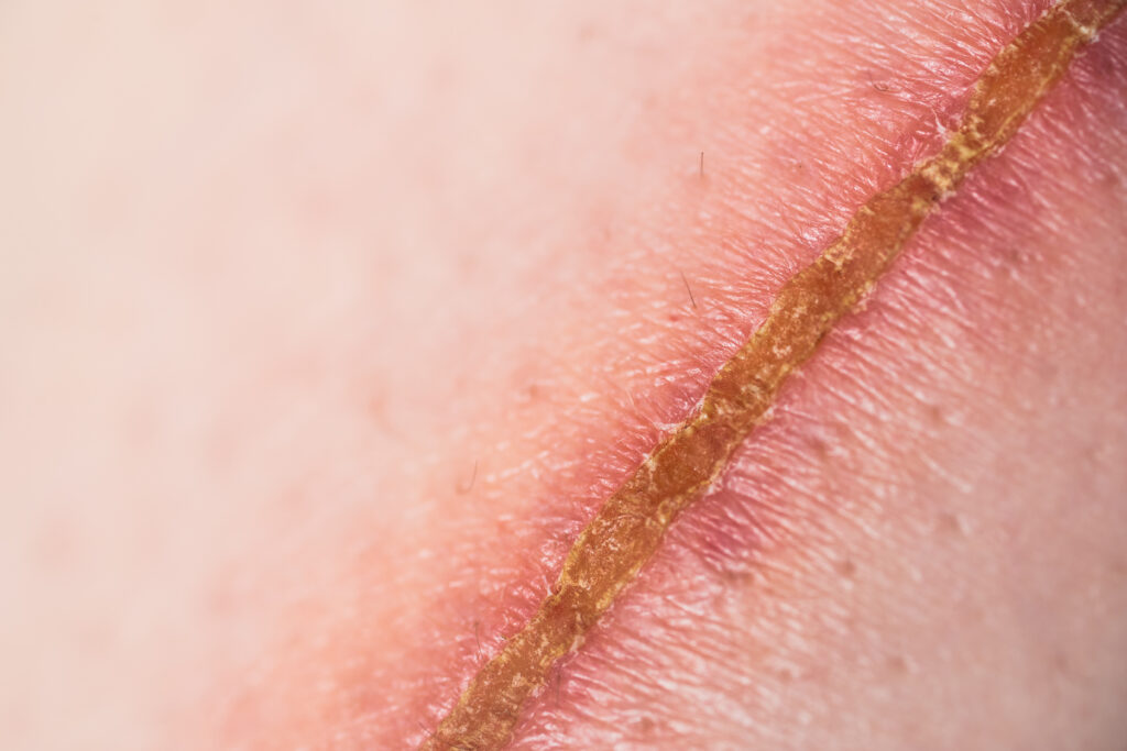 手術後に残った傷跡